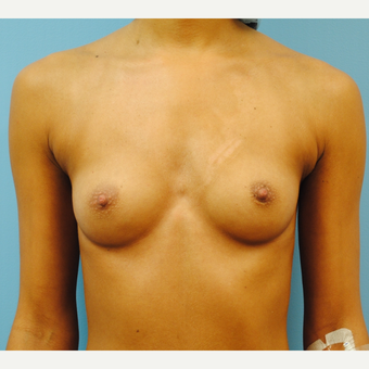 27 year old. Breast augmentation. A to full B cup. 300 cc high profile silicone. before 3304338