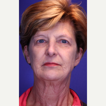 Facelift, Fractional CO2 Laser Skin Resurfacing before 3466401