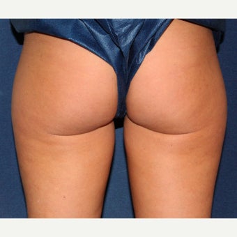 41 year old woman treated with CoolSculpting on the outer hips before 1723593