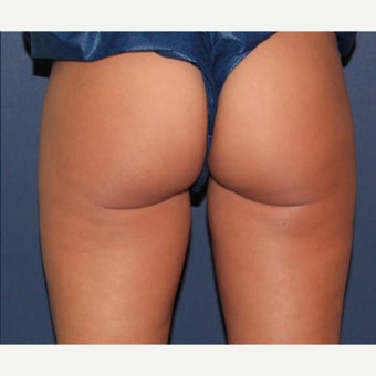 41 year old woman treated with CoolSculpting on the outer hips after 1723593