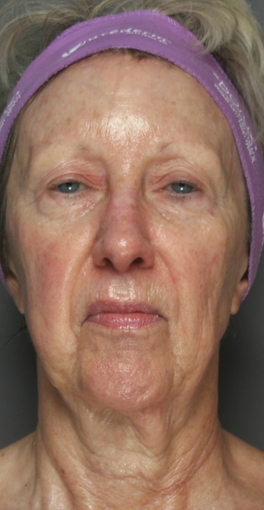 SmartSkin Laser before 275660