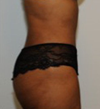 Abdominoplasty after 123631
