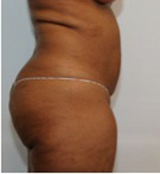 Abdominoplasty before 123631