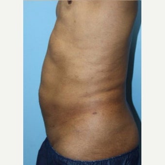 Liposuction Revision before 2132869