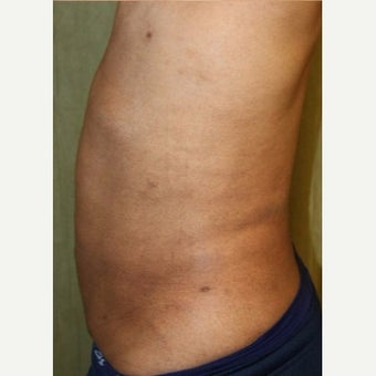 Liposuction Revision after 2132869