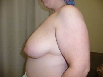 Ultimate Breast Reduction without implants exclusively by Gary Horndeski M.D. 1173028
