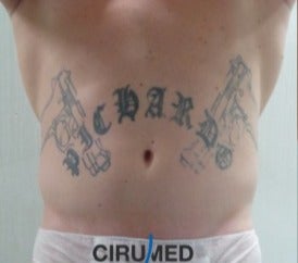Liposuction with abdominal etching to accentuate abdominal muscles before 3025059