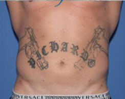 Liposuction with abdominal etching to accentuate abdominal muscles after 3025059