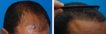 Hair Transplant Before & After - 46 Year-Old Male, 2600 Grafts, 20 Months Post Op 910208