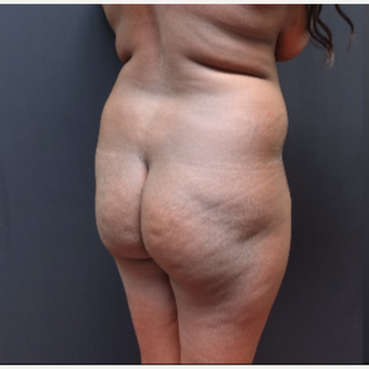 25-34 year old woman treated with Tumescent Liposuction before 3363769