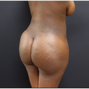 25-34 year old woman treated with Tumescent Liposuction after 3363769