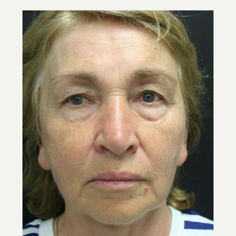55-64 year old woman treated with SMAS Facelift before 3405699