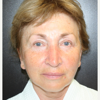 55-64 year old woman treated with SMAS Facelift after 3405699