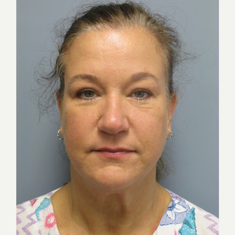 45-54 year old woman treated with Brow Lift after 3538795