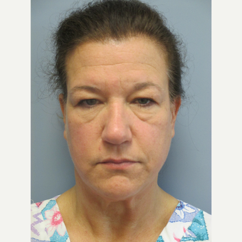 45-54 year old woman treated with Brow Lift before 3538795