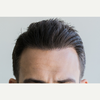 25-34 year old man treated with FUE Hair Transplant after 2749875