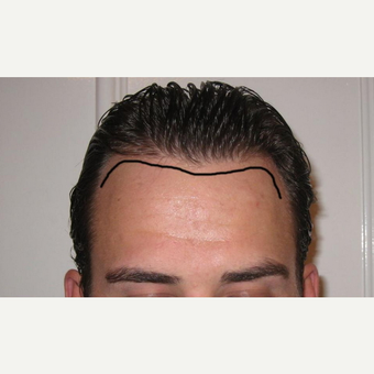 25-34 year old man treated with FUE Hair Transplant before 2749875