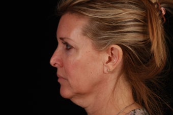 50 Year Old Female Cheek and Neck Lift and Lower Blepharoplasty before 1088965
