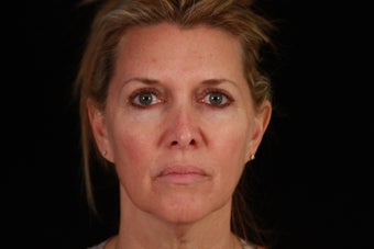 50 Year Old Female Cheek and Neck Lift and Lower Blepharoplasty 1088965
