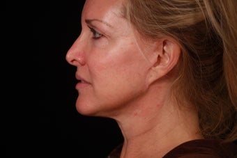 50 Year Old Female Cheek and Neck Lift and Lower Blepharoplasty after 1088965