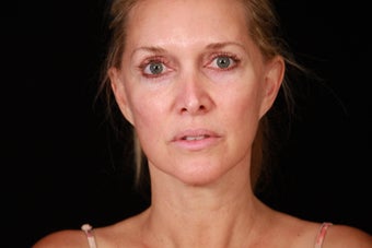 50 Year Old Female Cheek and Neck Lift and Lower Blepharoplasty 1088965