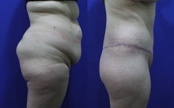 32 Year Old Treated for Abdominal Apron & Sagging Buttocks before 1109112
