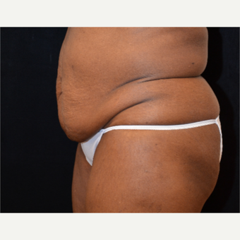 65-74 year old woman treated with Tummy Tuck before 3575529