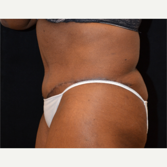 65-74 year old woman treated with Tummy Tuck after 3575529