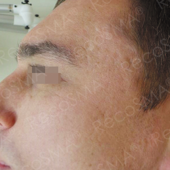 32 year old man with post-acne scars treated with RecoSMA after 2974600
