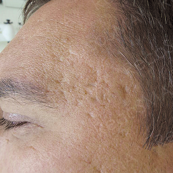 32 year old man with post-acne scars treated with RecoSMA before 2974600