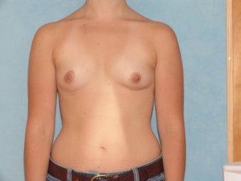 Female Seeking Natural Breast Augmentation using Fat Grafting before 656457