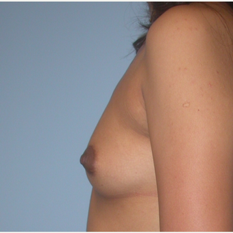 24 year old. Saline mod profile implants. 300 cc filled to 325 cc. A to small C before 3294417