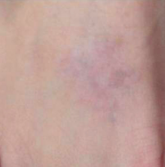 PicoSure after 1006791