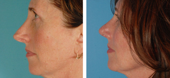 Revision Rhinoplasty before 1208281
