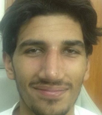18-24 year old man treated with Rhinoplasty after 2097260