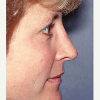 35-44 year old woman treated with Rhinoplasty after 3711398