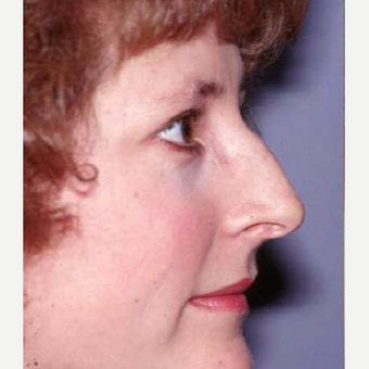35-44 year old woman treated with Rhinoplasty before 3711398