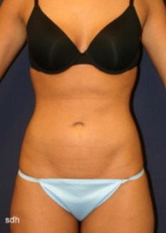 25-34 year old woman treated with Liposuction after 1670076