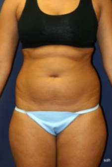 25-34 year old woman treated with Liposuction before 1670076