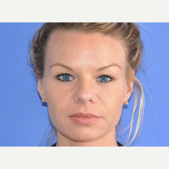 25-34 year old woman treated with Botox after 3214784