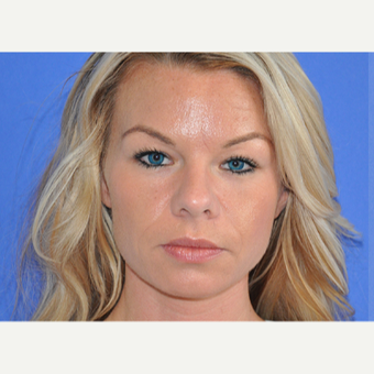 25-34 year old woman treated with Botox before 3214784