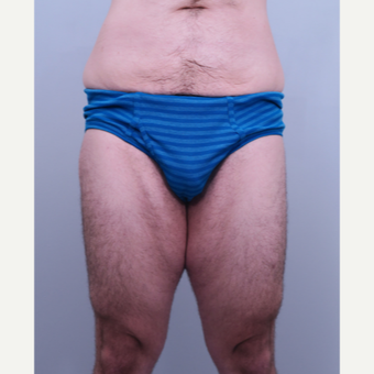 18-24 year old man treated with Thigh Lift before 3406434