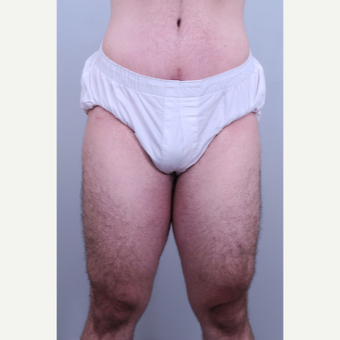 18-24 year old man treated with Thigh Lift after 3406434