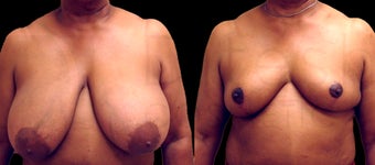 53 yr old African american woman before and after breast reduction procedure before 1141902
