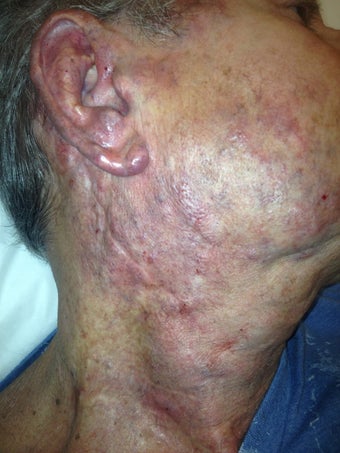 67 year old male with extensive hemangioma of face, neck and ear after 977896