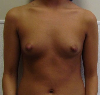 Saline Breast Implants for this 19 Year Old Woman 1394636