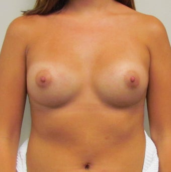 Saline Breast Implants for this 19 Year Old Woman 1394636