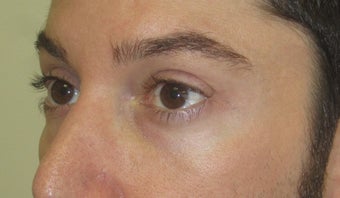 Injectable fillers to lower lids and midface before 1391324