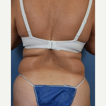55-64 year old woman treated with Liposuction before 3588893