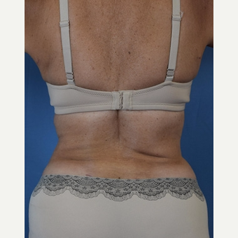 55-64 year old woman treated with Liposuction after 3588893